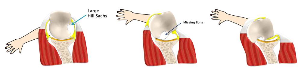 Shoulder Instability